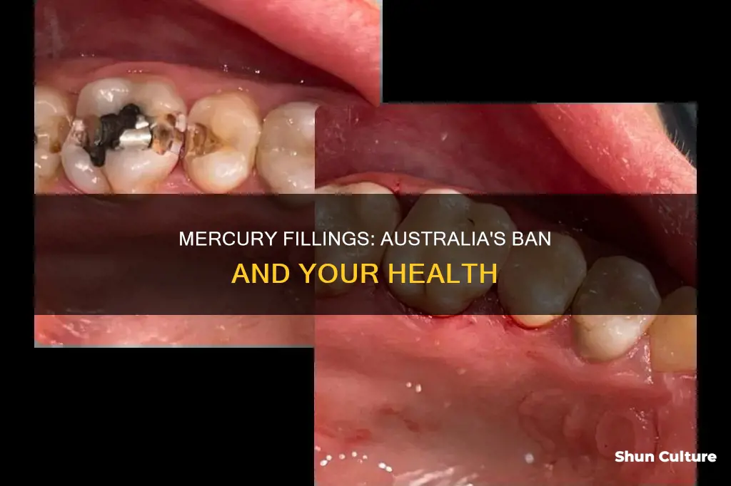 are mercury fillings banned in australia