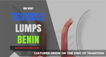 Understanding Testicle Lumps: The Majority Are Benign