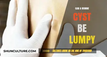 Understanding Benign Cysts: Can They Be Lumpy?
