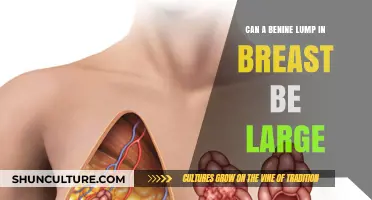 Exploring the Size of Benign Breast Lumps: Facts and Myths