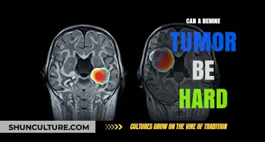 Understanding Benign Tumors: Can They Be Hard to Detect?