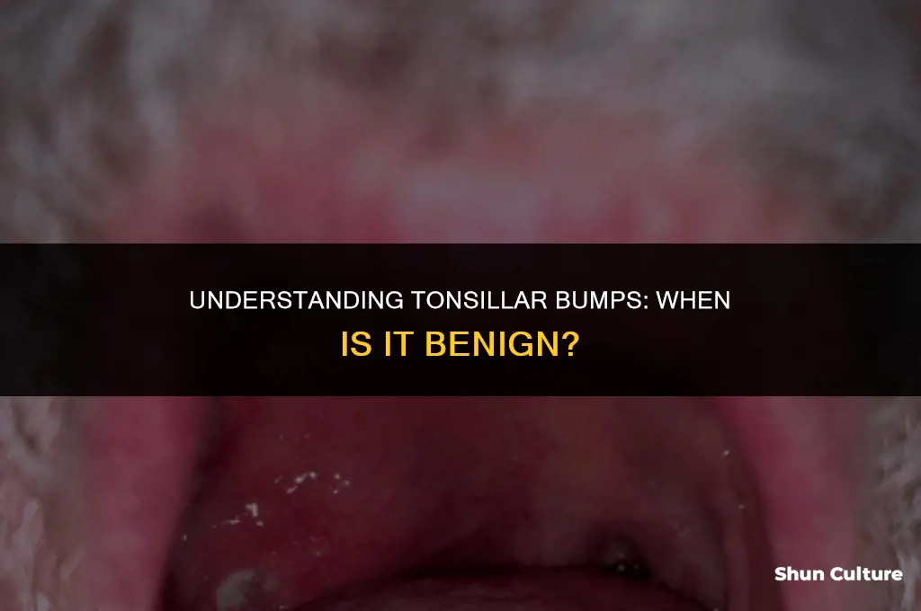 can a bump on your tonsil be benine