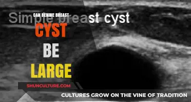 Understanding Benign Breast Cysts: Can They Grow Large?