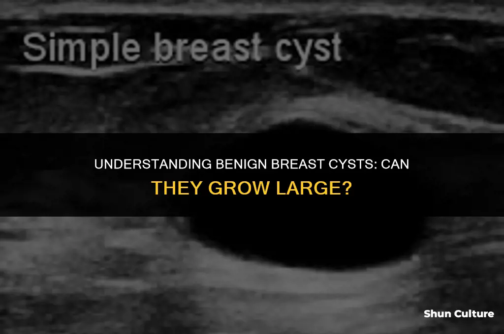 can benine breast cyst be large