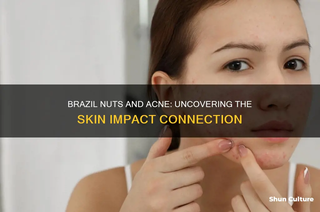 can brazil nuts cause acne