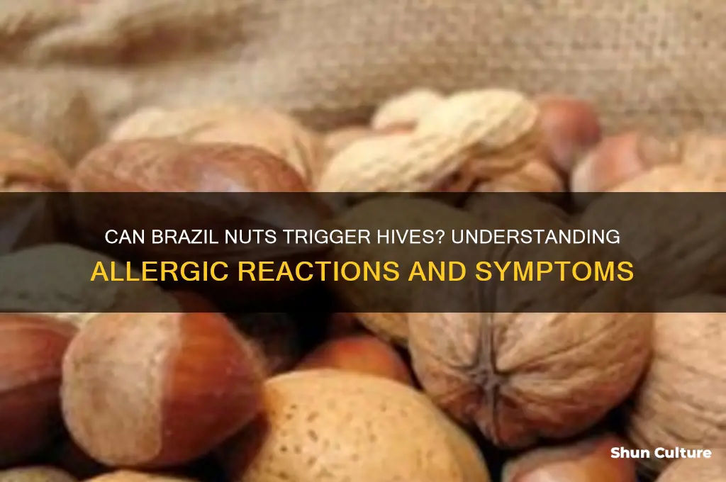 can brazil nuts cause hives