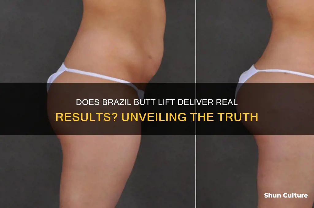 does brazil butt lift really work