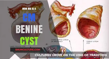 Understanding the Size of a 5 cm Benign Cyst: A Comprehensive Guide