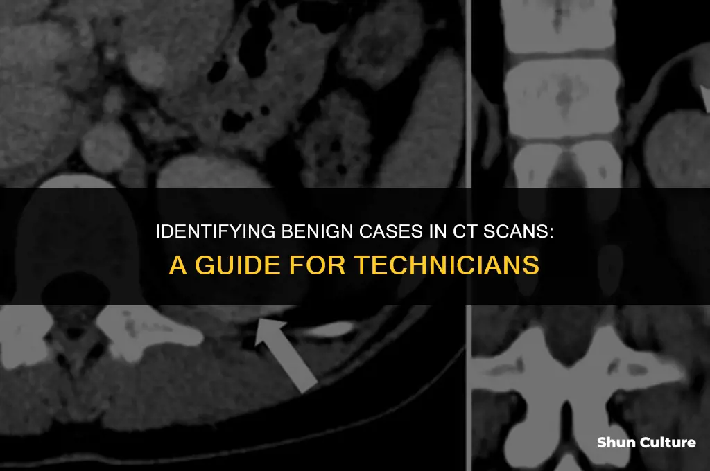 how can a ct tech know something is benine