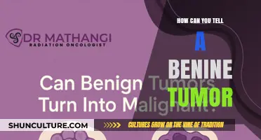 Distinguishing Benign Tumors: A Guide to Recognizing Non-Cancerous Growths