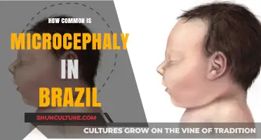 Microcephaly in Brazil: Prevalence, Causes, and Public Health Impact