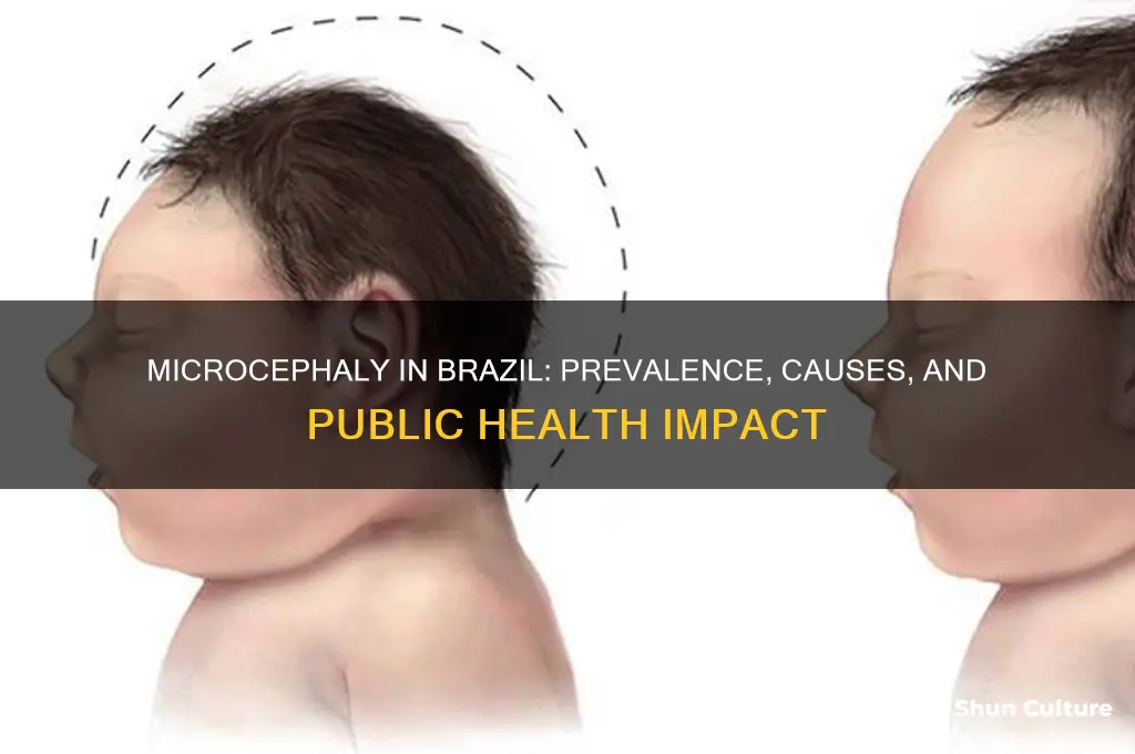 how common is microcephaly in brazil