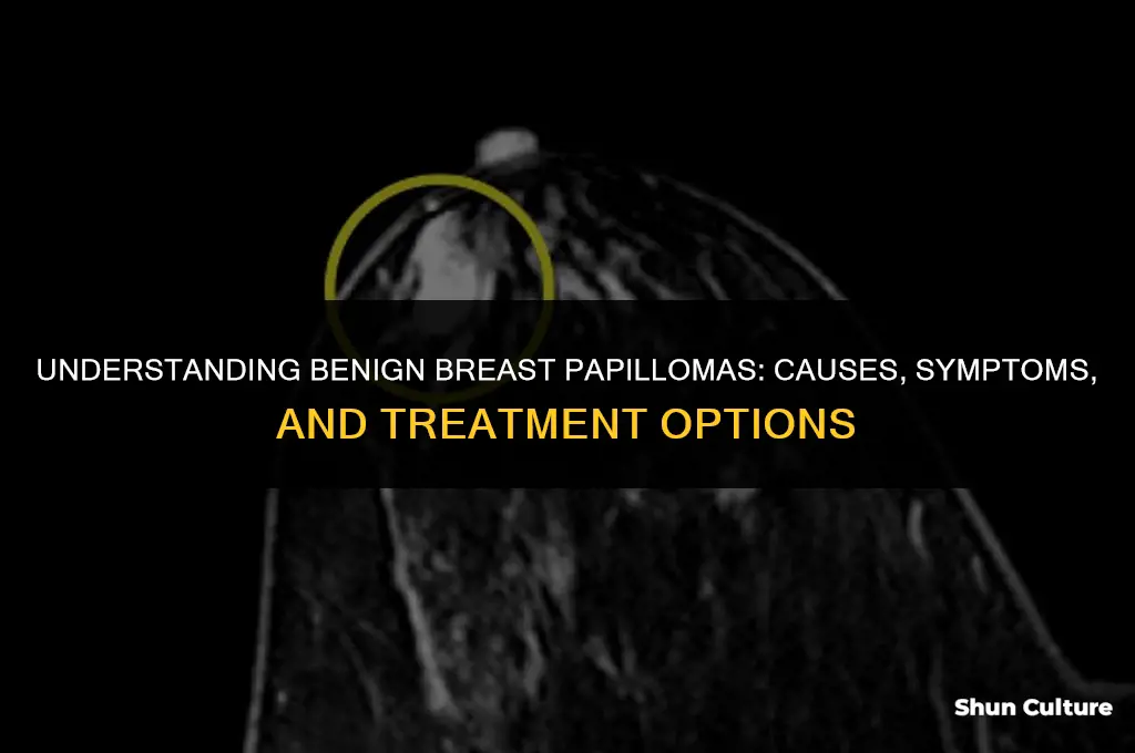 how do you get benine breast papolomas