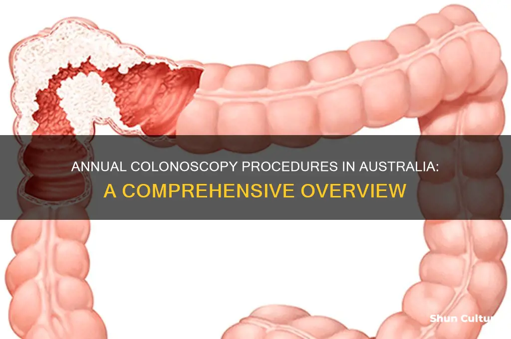 how many colonoscopies are performed each year in australia