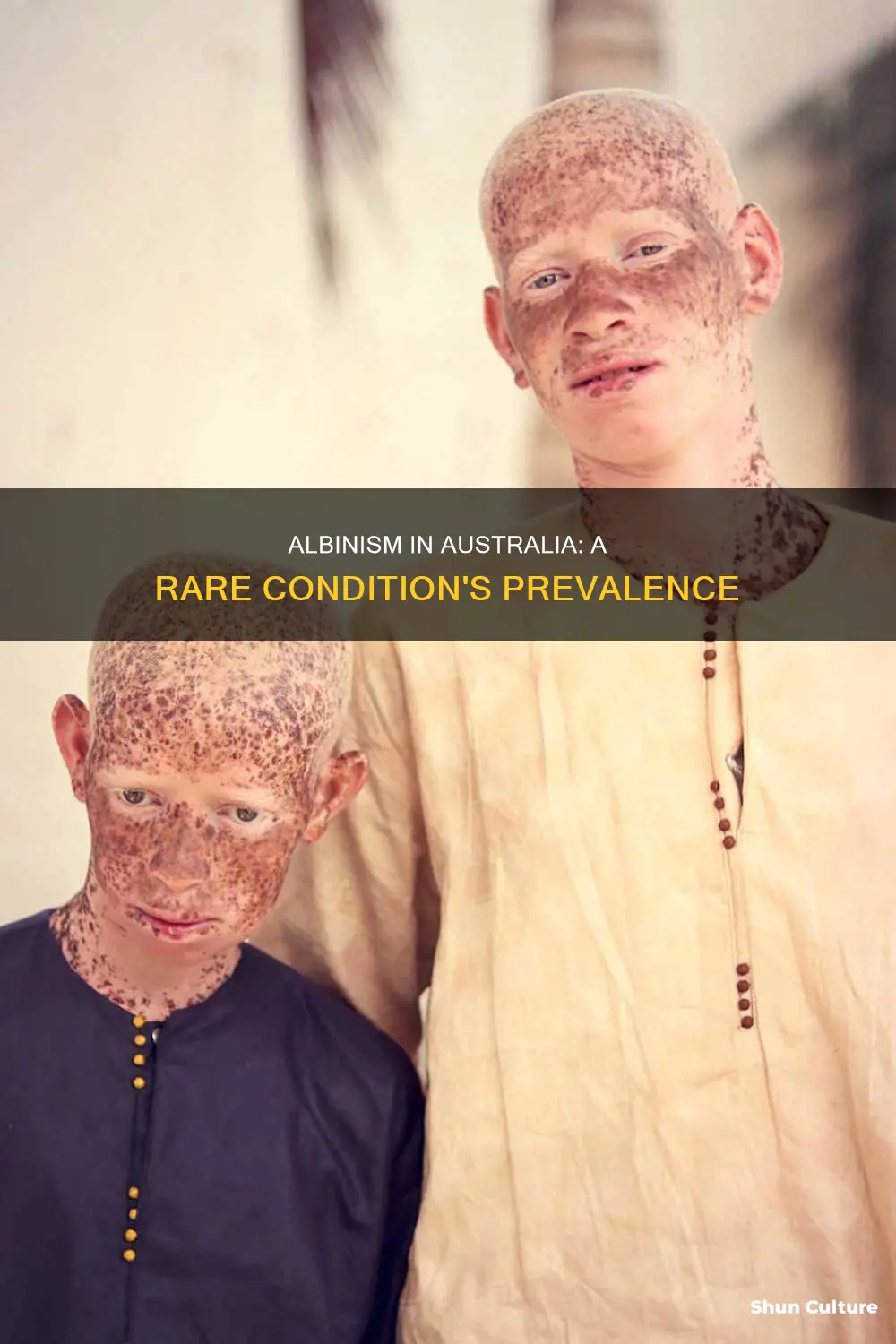 how many people have albinism in australia