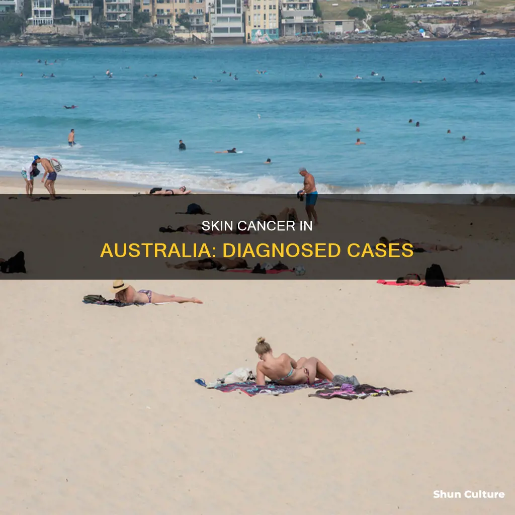 how many people have been diagnosed withskin cancer in australia