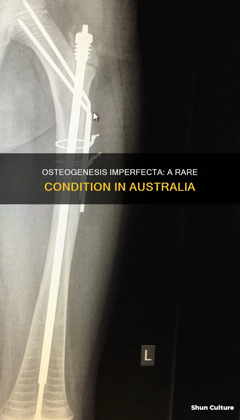how many people in australia have osteogenesis imperfecta