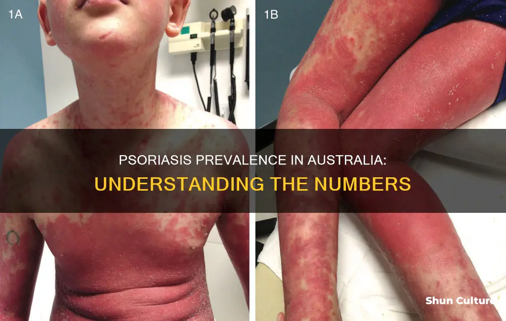 how many people in australia have psoriasis