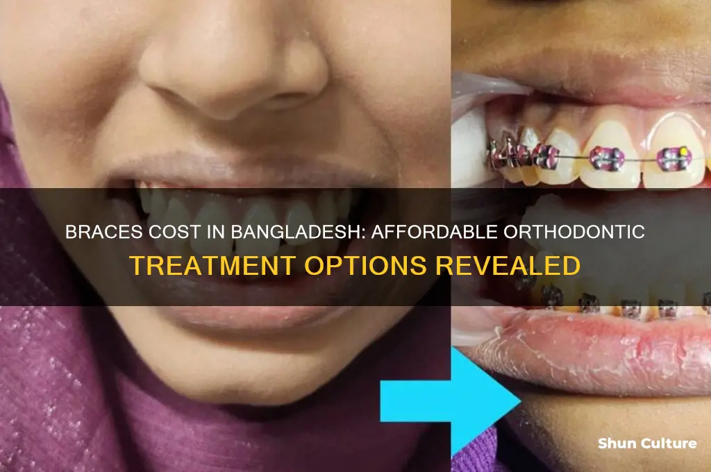 how much does it cost to wear braces in bangladesh