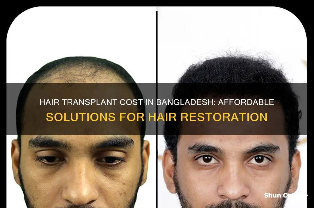 how much hair transplant cost in bangladesh