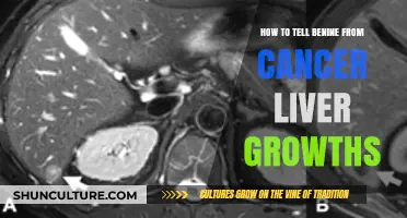 Distinguishing Benign Liver Growths from Cancer: A Comprehensive Guide