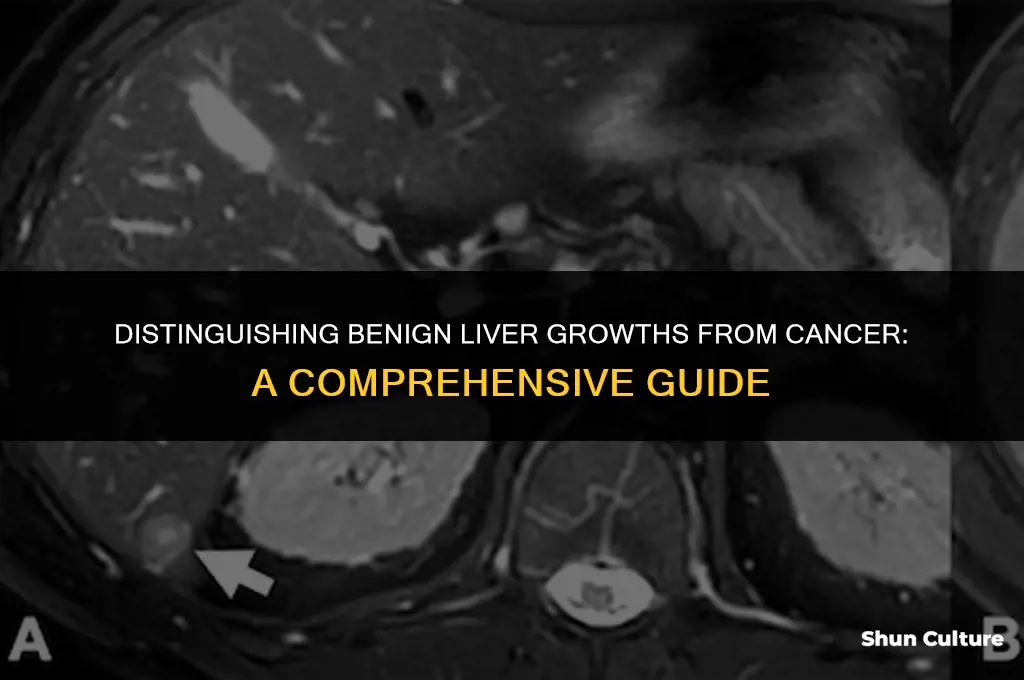 how to tell benine from cancer liver growths