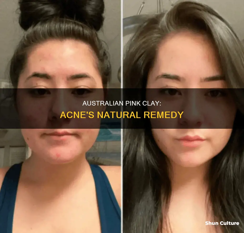 is australian pink clay good for acne