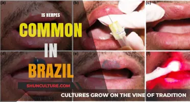 Herpes Prevalence in Brazil: Understanding the Commonality and Impact