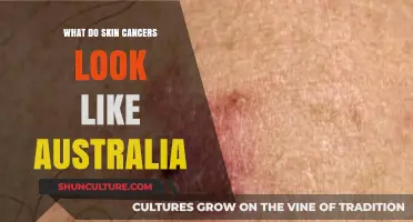 Skin Cancer: What to Look Out For in Australia