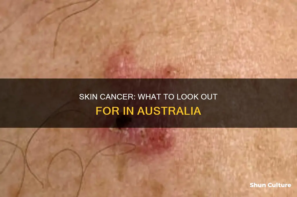 what do skin cancers look like australia