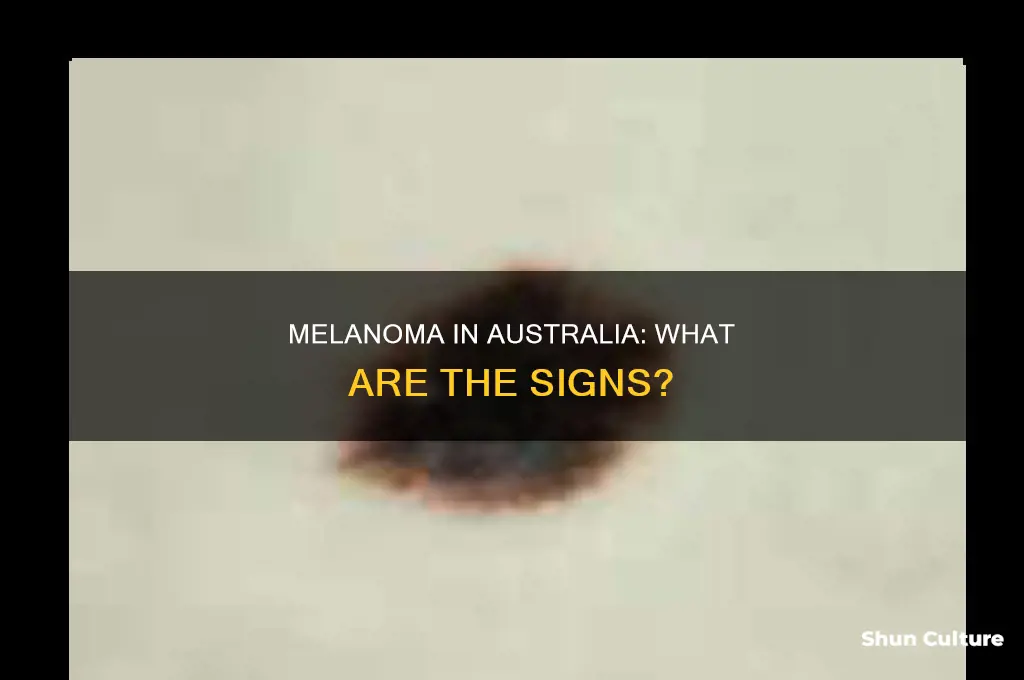 what does a melanoma look like australia