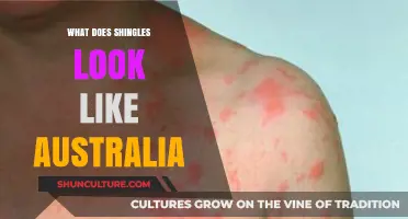 Shingles in Australia: What Are the Symptoms and Signs?