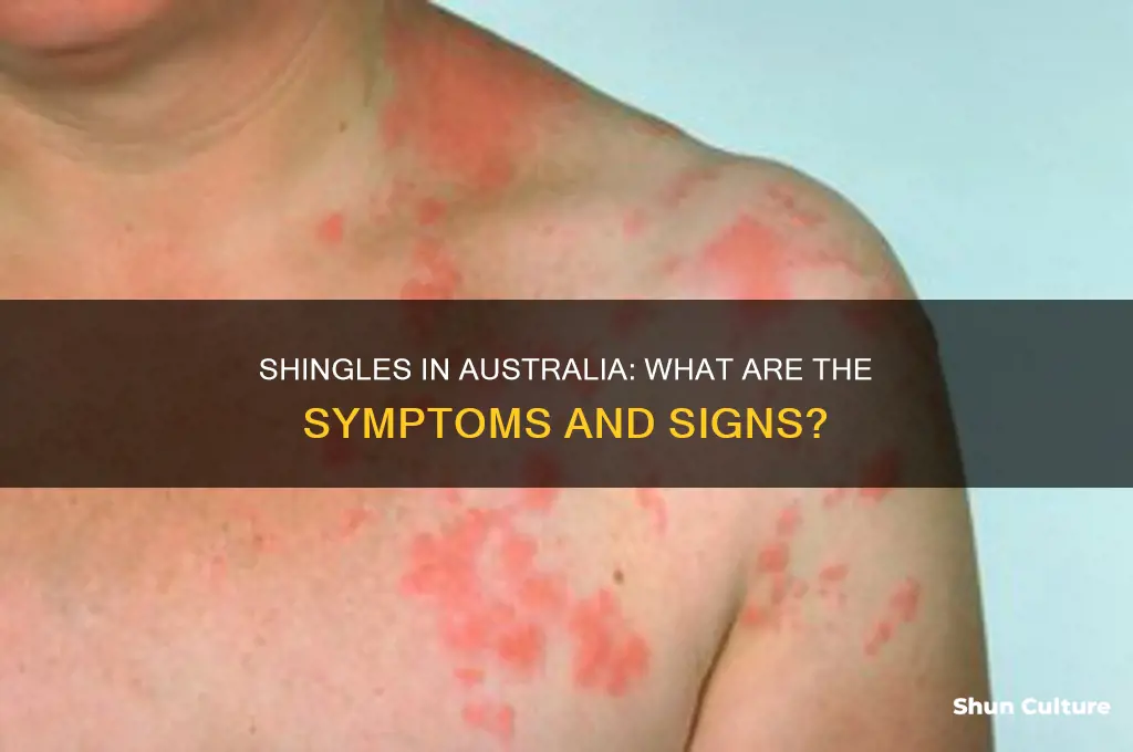 what does shingles look like australia