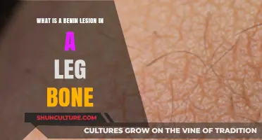 Understanding Benin Lesions: A Comprehensive Guide to Leg Bone Health
