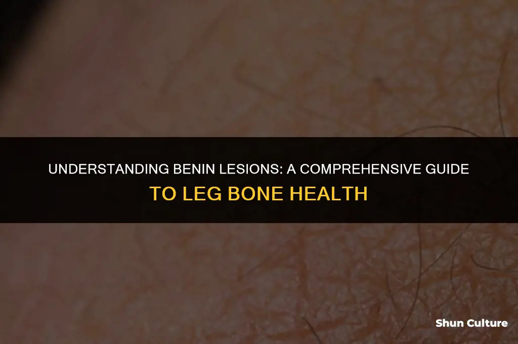 what is a benin lesion in a leg bone