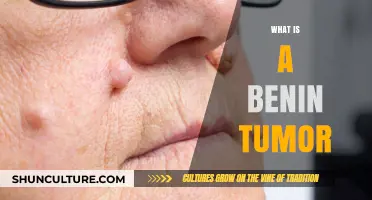 Understanding Benign Tumors: A Comprehensive Guide