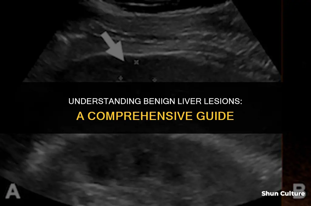 what is benine stuff on the liver