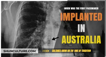 Australia's First Pacemaker Implant: A Historic Medical Milestone