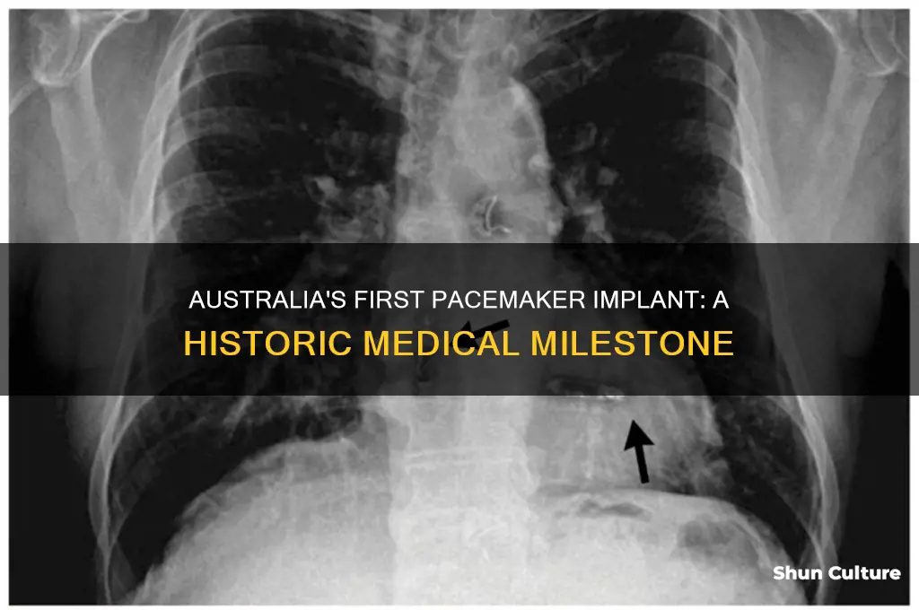 when was the first pacemaker implanted in australia